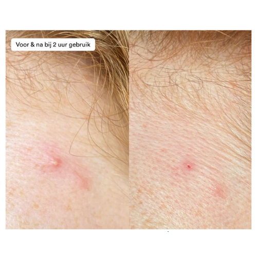 
                      
                        Ray - acne - puistjes pasta
                      
                    